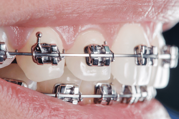Dental Braces 